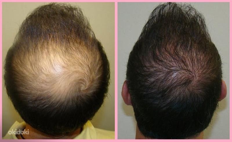 Мальчиков начинают расти волосы. Minoxidil 2%. Миноксидил алерана эффект. Андрогенная алопеция миноксидил.