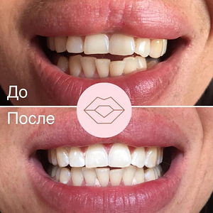 Hammaste fotovalgenduse teenus (3 foto / 4)