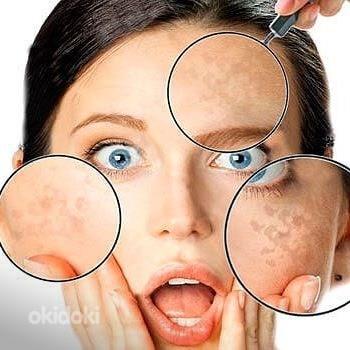 Akne ja noorukite naha ravi + fototeraapia (foto #1)