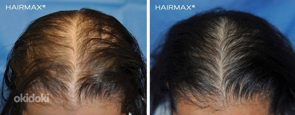 Курс против выпадения волос (фото #4)