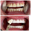 Отбеливание зубов (фото #1)